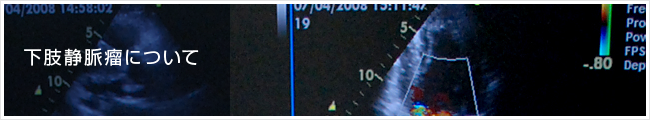 下肢静脈瘤について