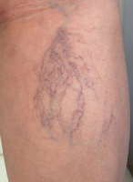 クモの巣状静脈瘤