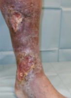 静脈瘤による潰瘍