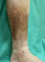 静脈瘤による色素沈着